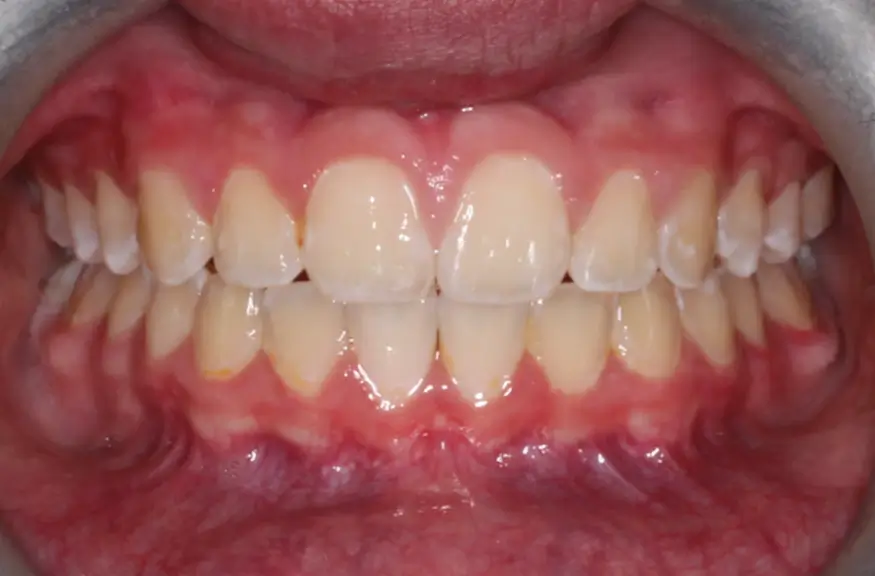 After Intraoral Centre Tooth Photo