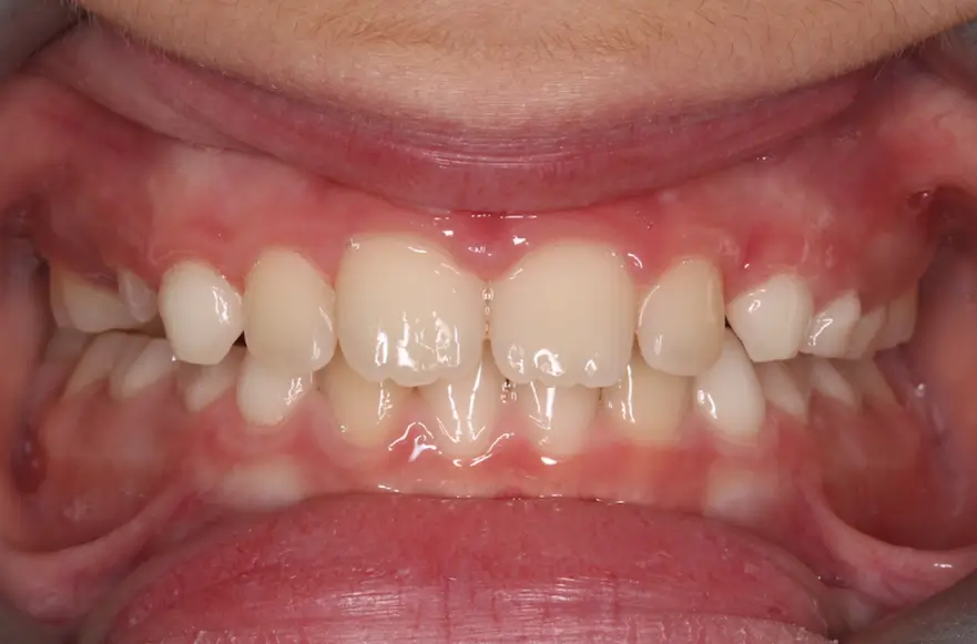 After Intraoral Centre Tooth Photo