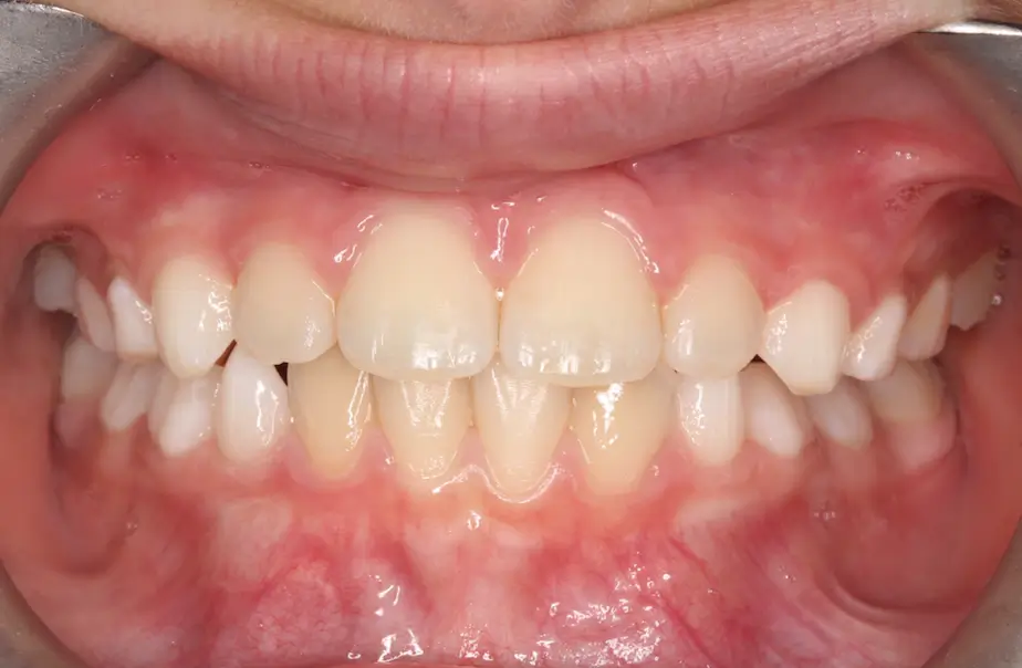 After Intraoral Centre Tooth Photo