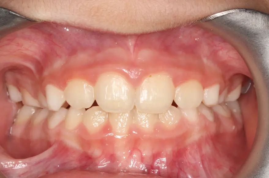 After Intraoral Centre Tooth Photo