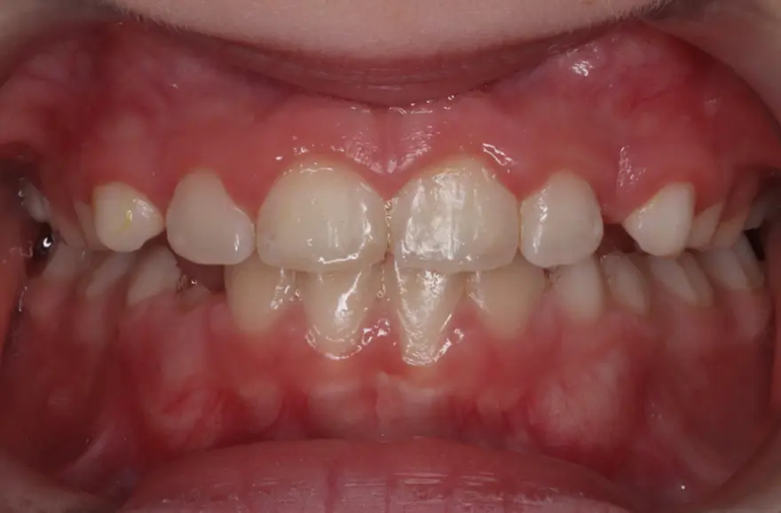 After Intraoral Centre Tooth Photo