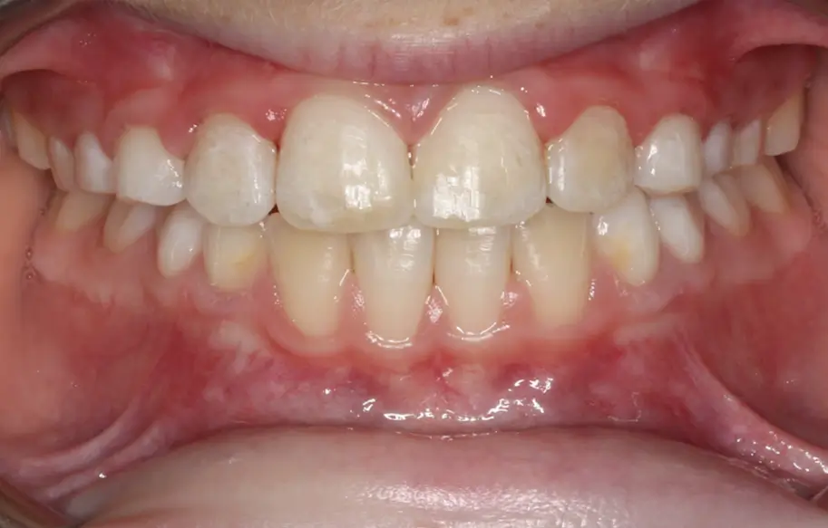 After Intraoral Centre Tooth Photo