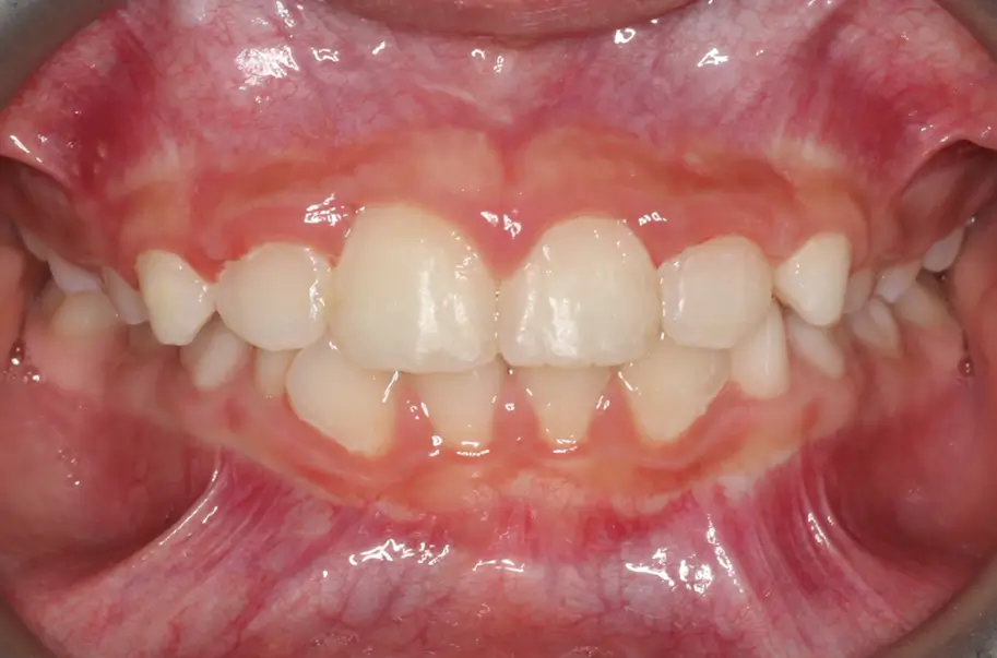 After Intraoral Centre Tooth Photo