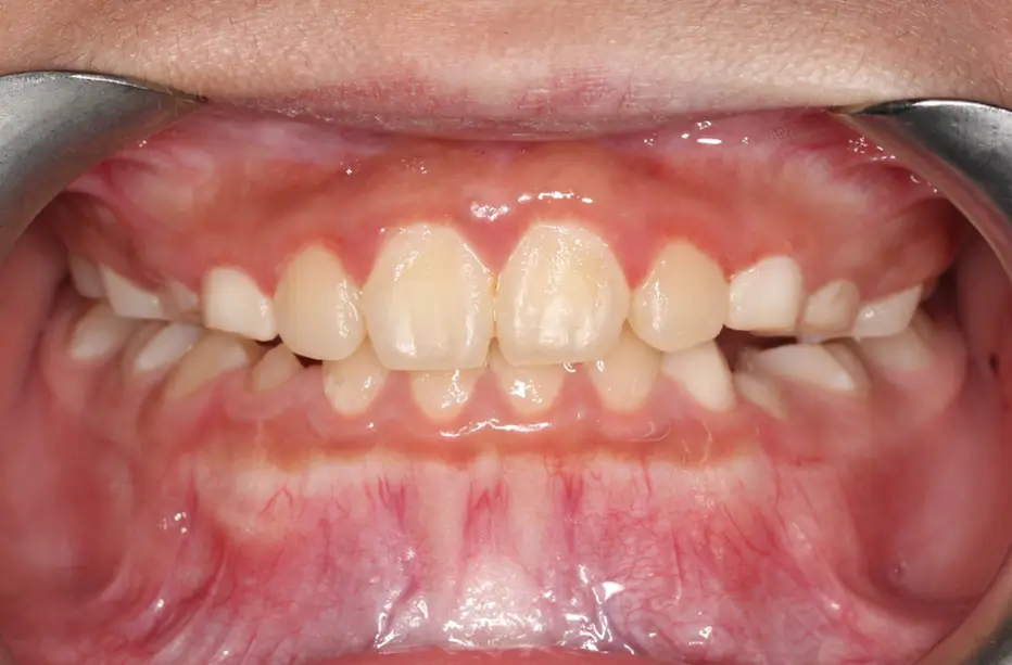After Intraoral Centre Tooth Photo