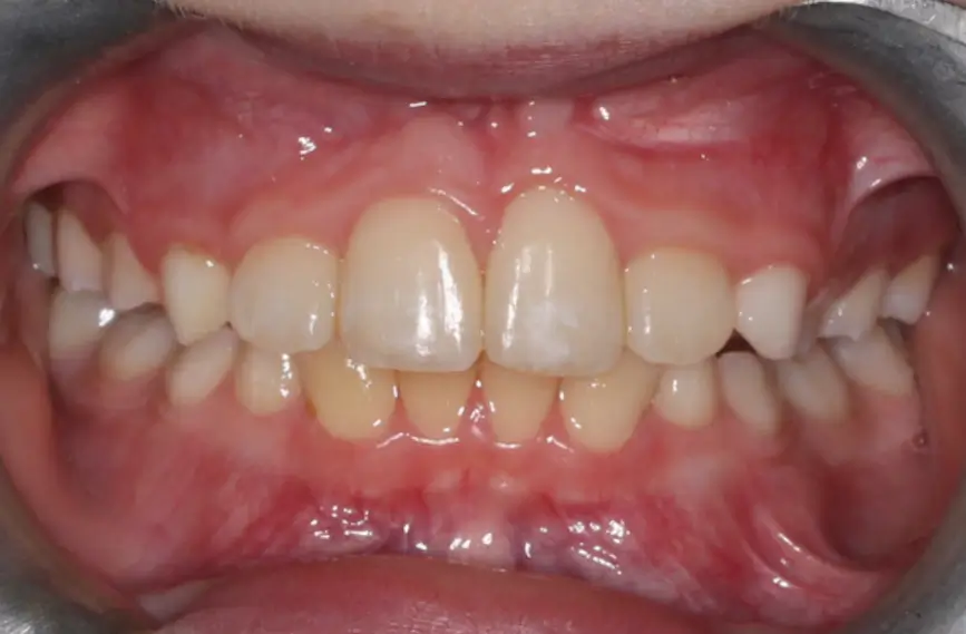 After Intraoral Centre Tooth Photo
