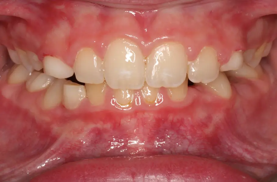 After Intraoral Centre Tooth Photo