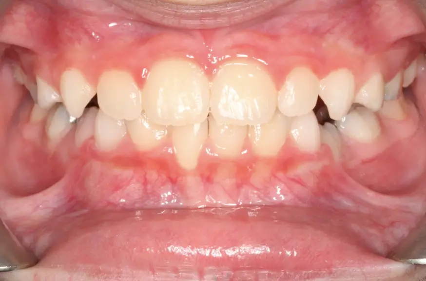 After Intraoral Centre Tooth Photo