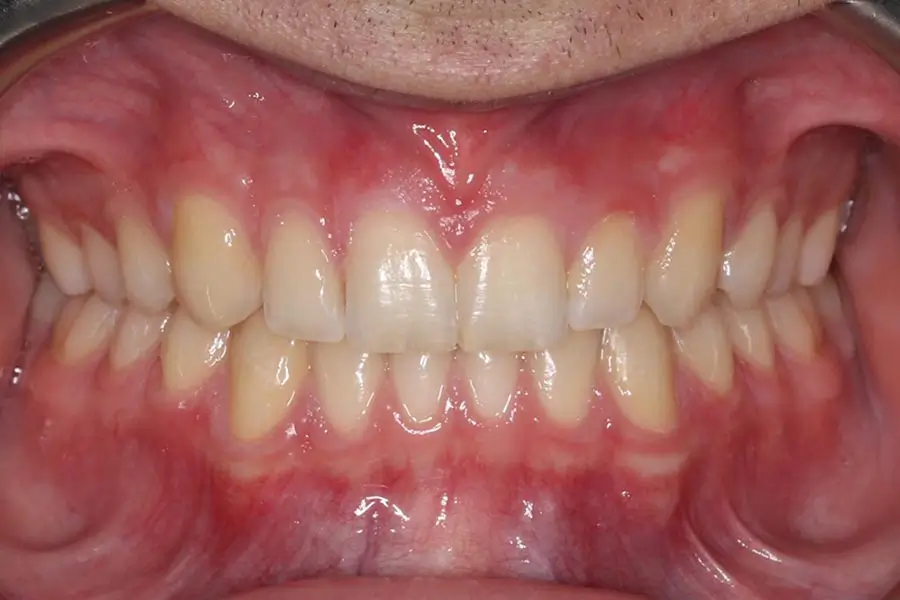 After Intraoral Centre Tooth Photo