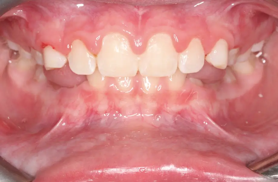 After Intraoral Centre Tooth Photo