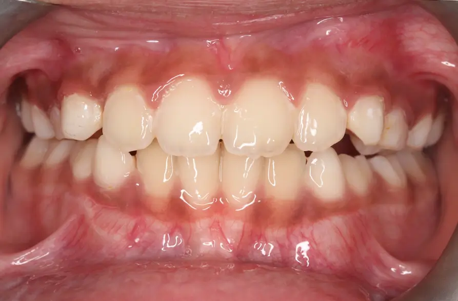 After Intraoral Centre Tooth Photo