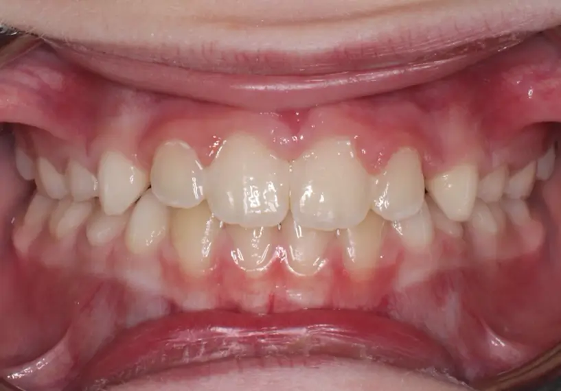 After Intraoral Centre Tooth Photo