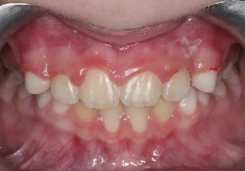 After Intraoral Centre Tooth Photo