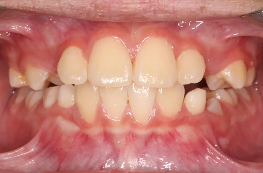 After Intraoral Centre Tooth Photo