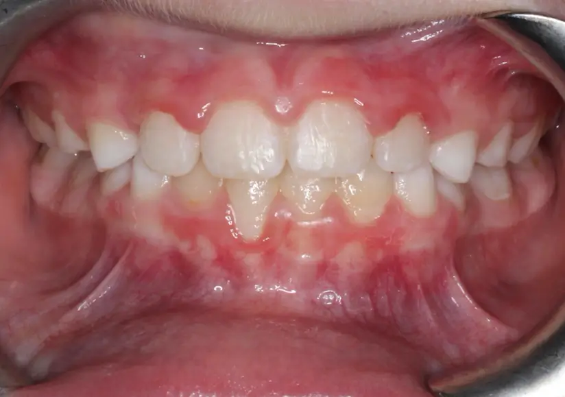 After Intraoral Centre Tooth Photo