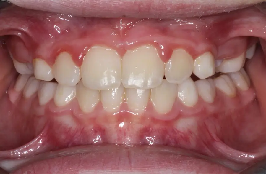After Intraoral Centre Tooth Photo