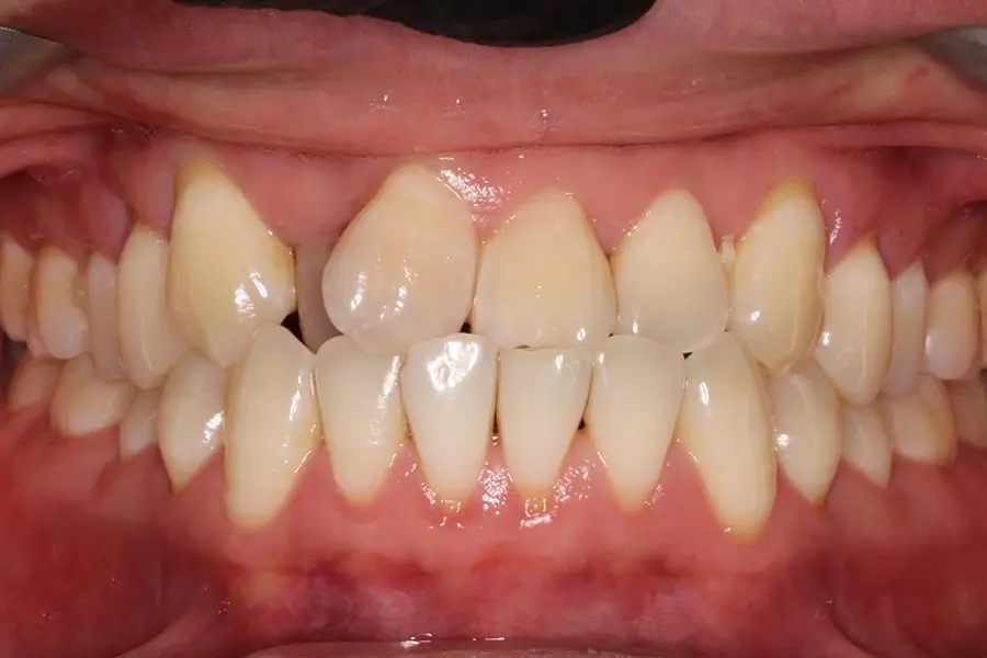 Before Intraoral Centre Tooth Photo
