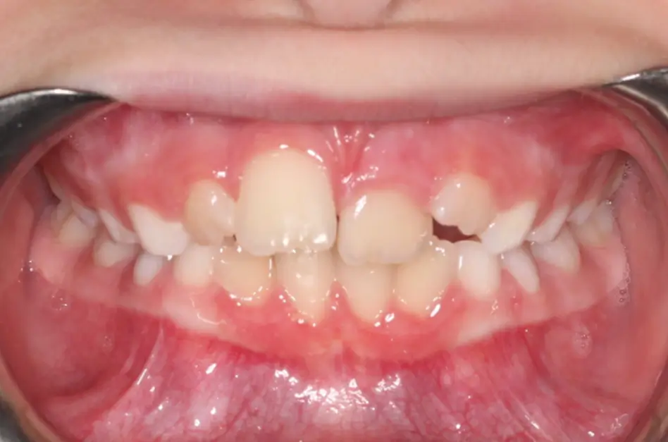 Before Intraoral Centre Tooth Photo