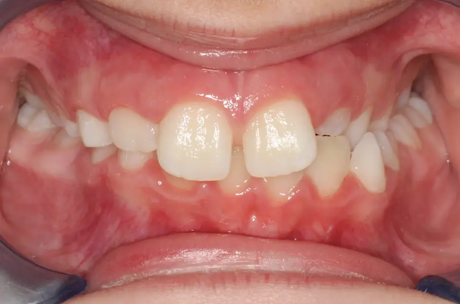 Before Intraoral Centre Tooth Photo