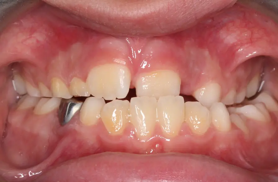 Before Intraoral Centre Tooth Photo