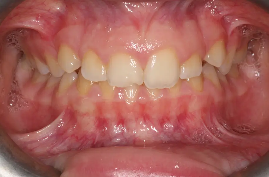 Before Intraoral Centre Tooth Photo