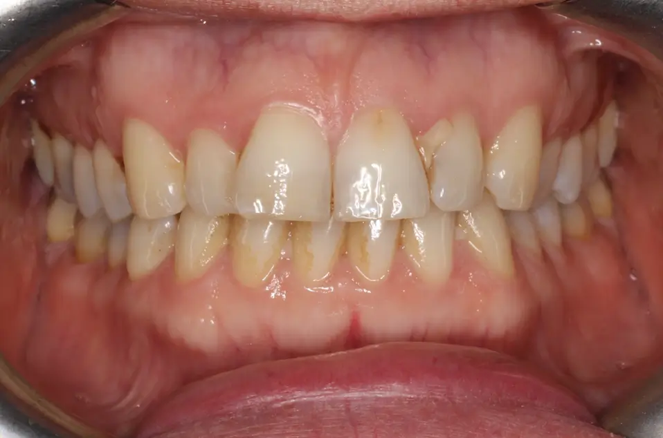 Before Intraoral Centre Tooth Photo