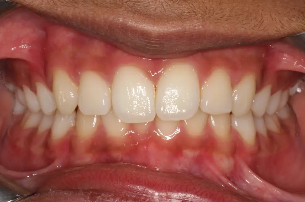 Before Intraoral Centre Tooth Photo