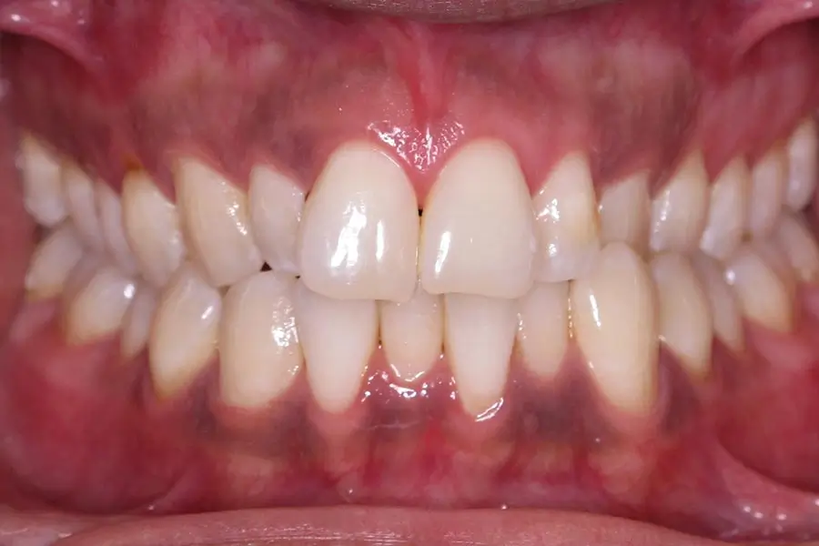 Before Intraoral Centre Tooth Photo