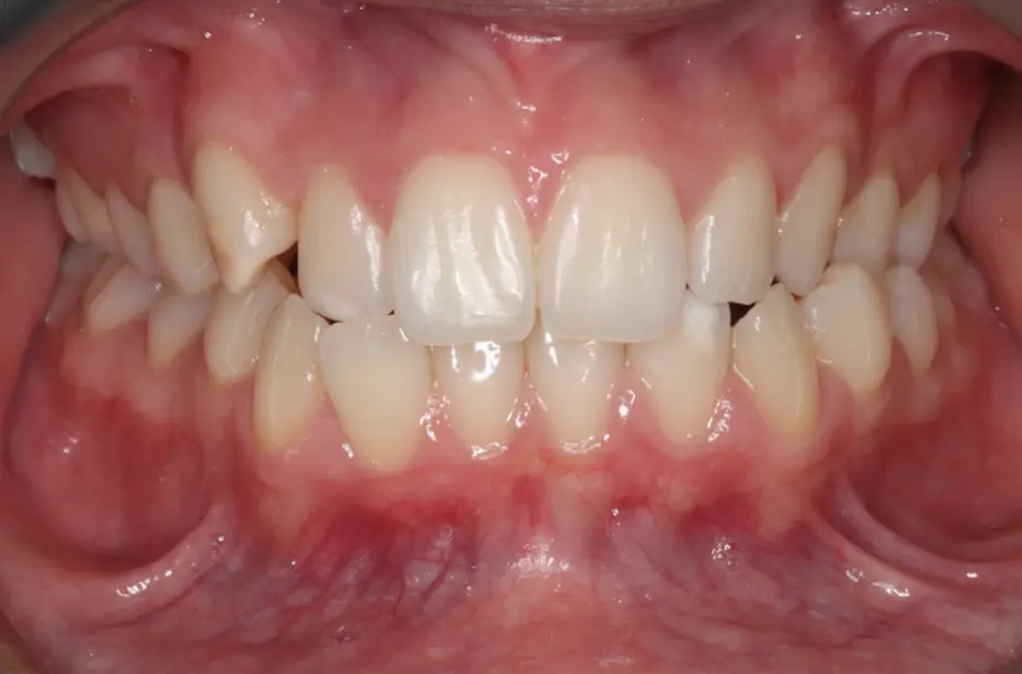 Before Intraoral Centre Tooth Photo
