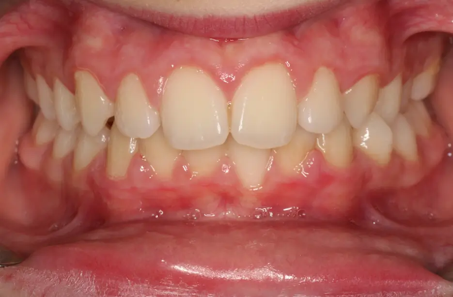 Before Intraoral Centre Tooth Photo