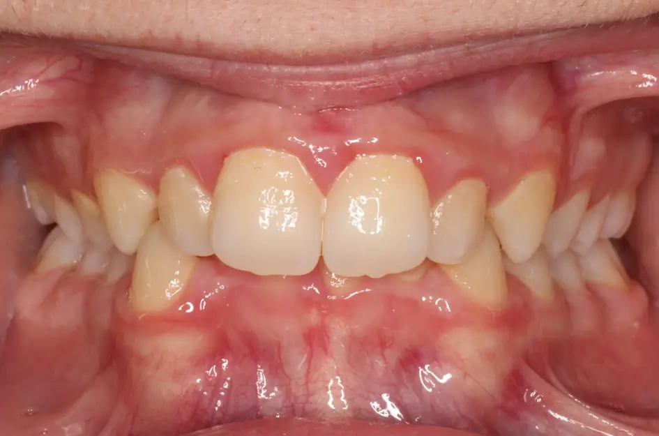 Before Intraoral Centre Tooth Photo