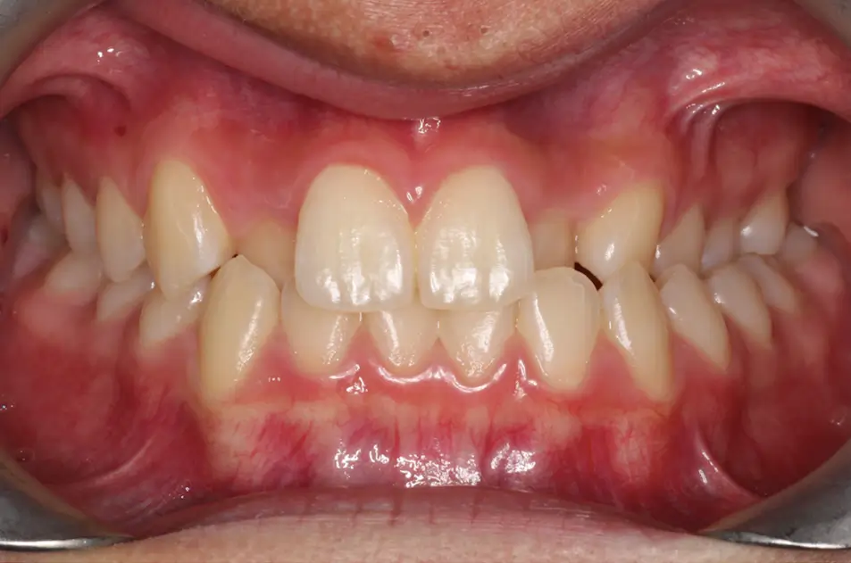 Before Intraoral Centre Tooth Photo