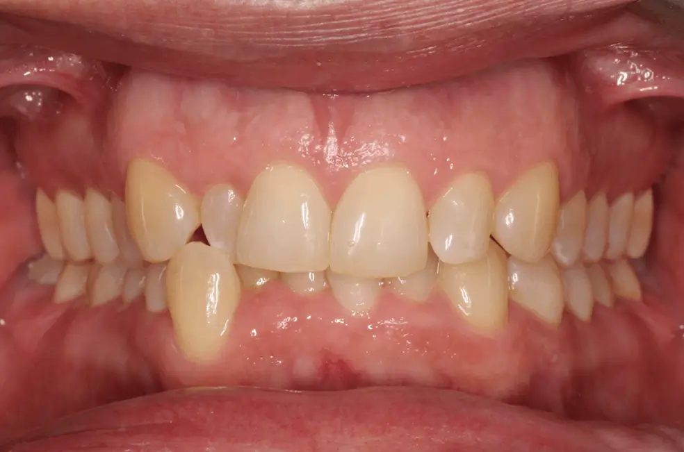 Before Intraoral Centre Tooth Photo