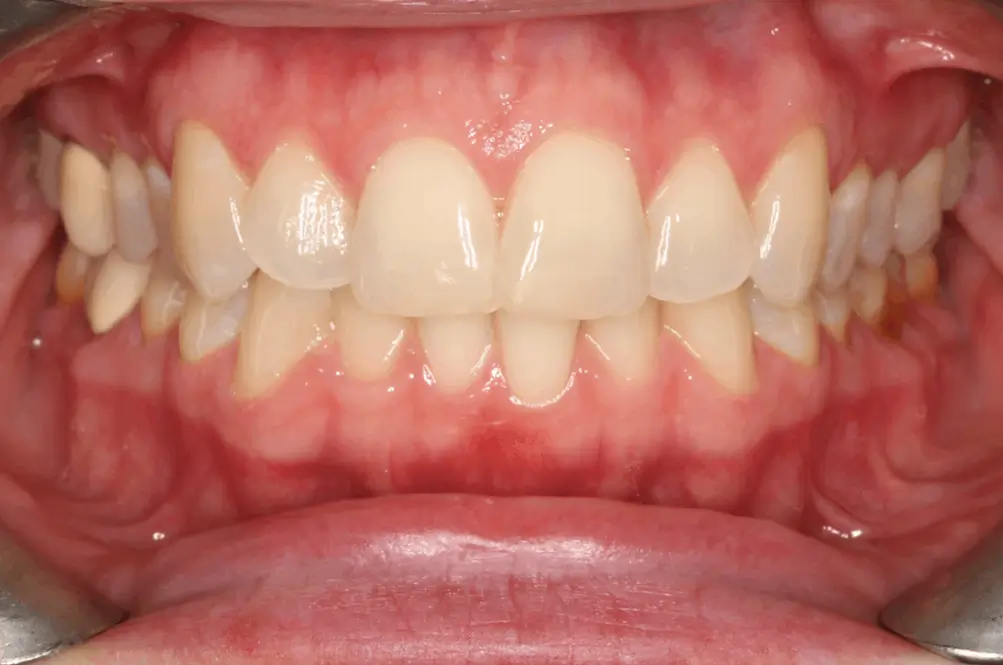 Before Intraoral Centre Tooth Photo