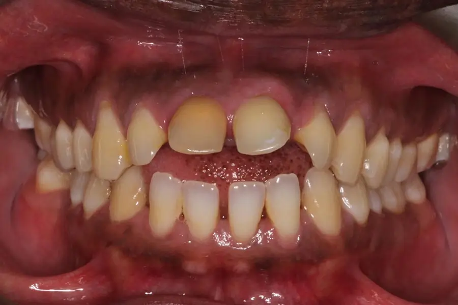 Before Intraoral Centre Tooth Photo