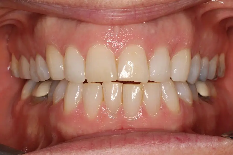 Before Intraoral Centre Tooth Photo