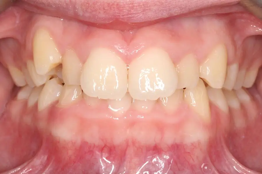Before Intraoral Centre Tooth Photo
