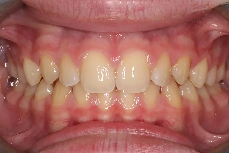 Before Intraoral Centre Tooth Photo