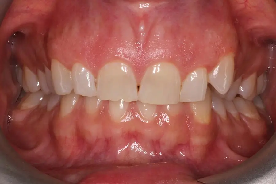 Before Intraoral Centre Tooth Photo