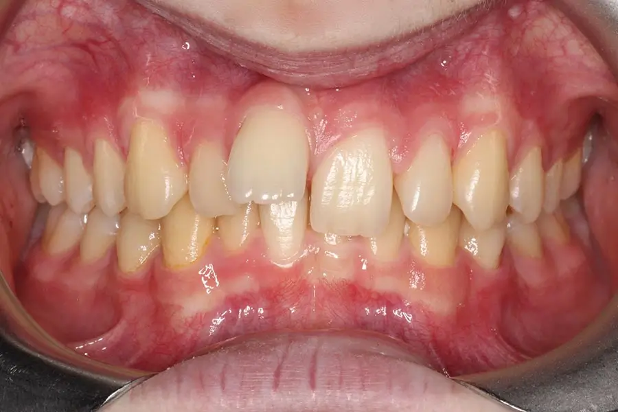 Before Intraoral Centre Tooth Photo