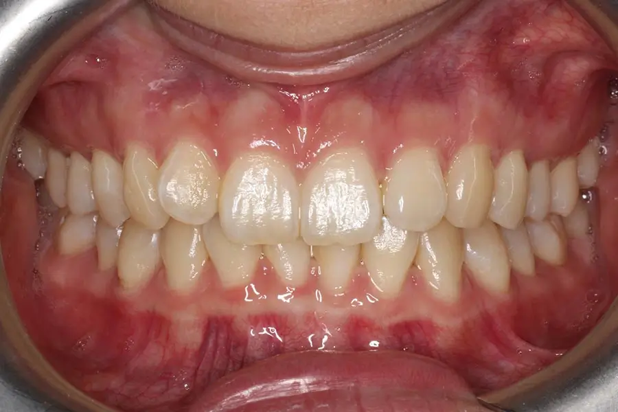 Before Intraoral Centre Tooth Photo