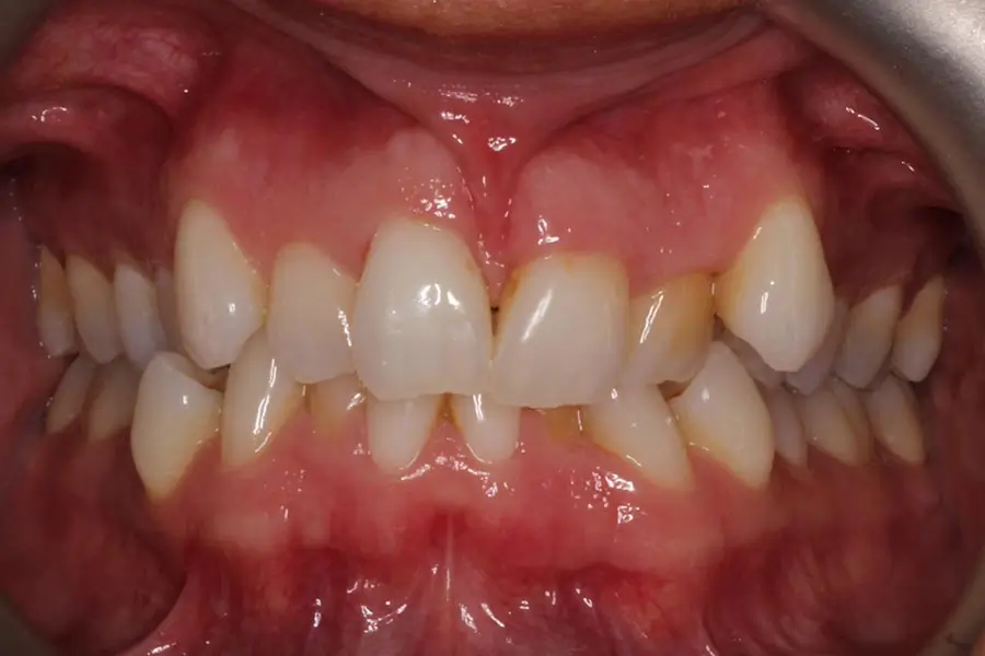 Before Intraoral Centre Tooth Photo