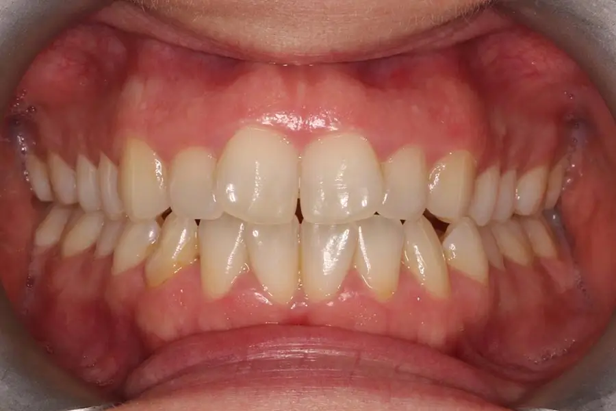 Before Intraoral Centre Tooth Photo
