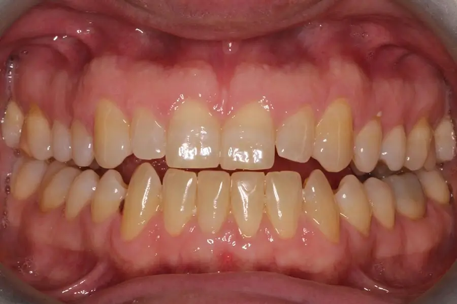Before Intraoral Centre Tooth Photo
