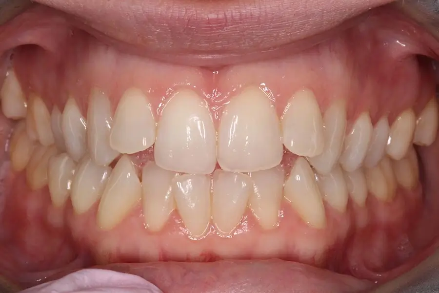 Before Intraoral Centre Tooth Photo