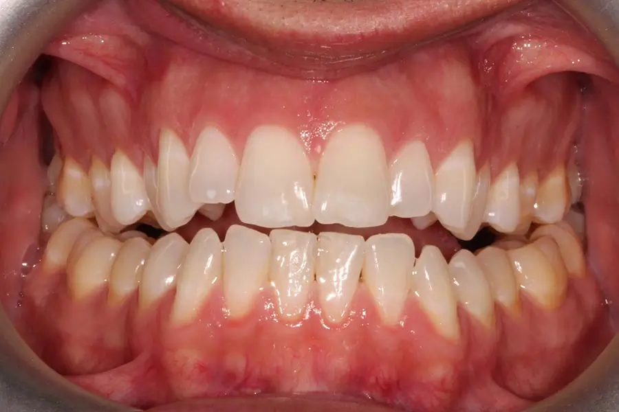 Before Intraoral Centre Tooth Photo