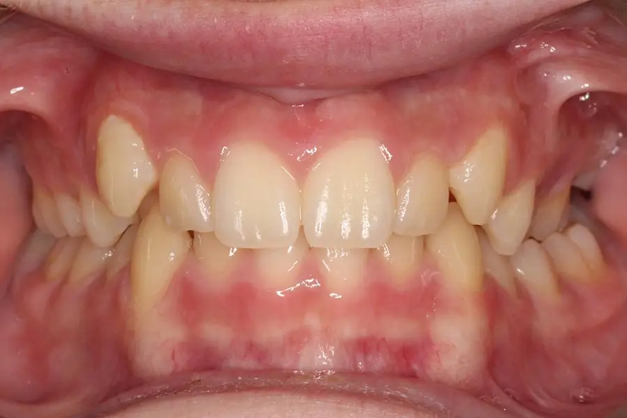 Before Intraoral Centre Tooth Photo