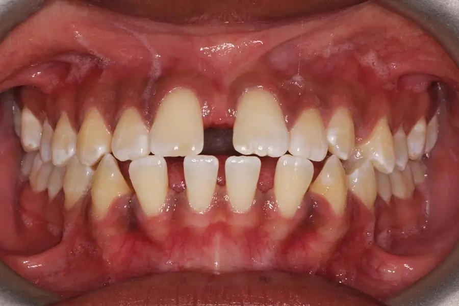 Before Intraoral Centre Tooth Photo
