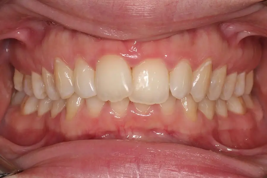 Before Intraoral Centre Tooth Photo