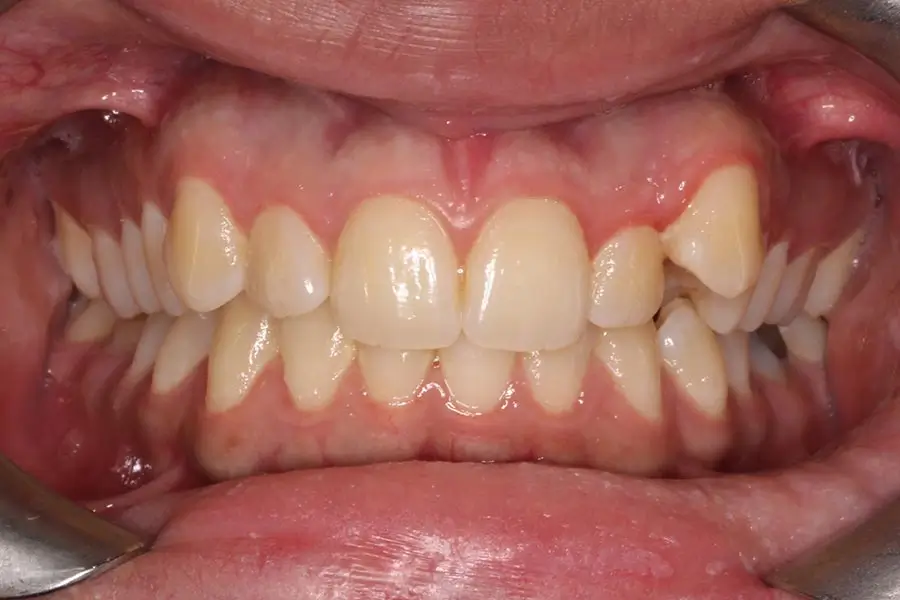 Before Intraoral Centre Tooth Photo
