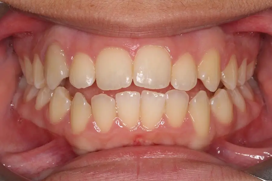 Before Intraoral Centre Tooth Photo
